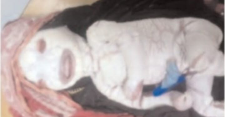 यहाँ हार्लेक्विन इक्थियोसिस बीमारी से जन्मे नवजात की मौत…….